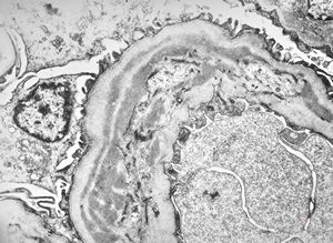type I membranoproliferative glomerulonephritis type I membranoproliferative glomerulonephritis